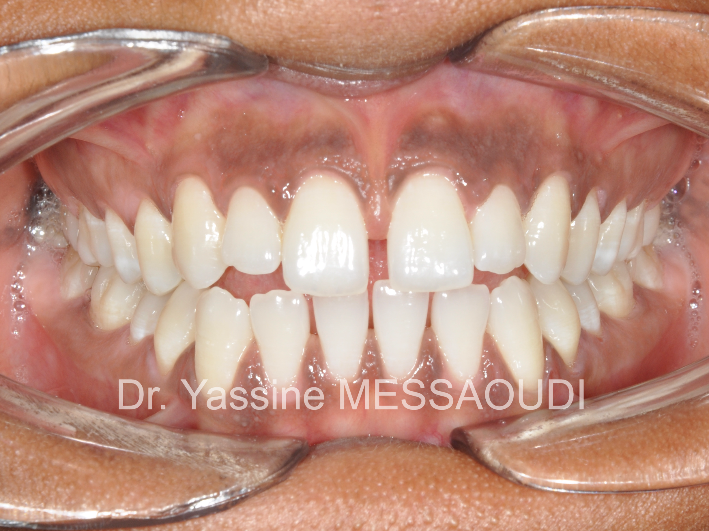 Diastèmes - Avant traitement